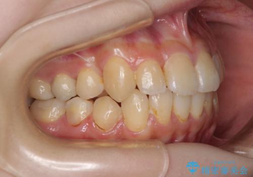 デコボコ歯列をきれいに　インビザラインによる矯正治療の治療中