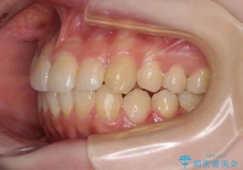 デコボコ歯列をきれいに インビザラインによる矯正治療の治療中