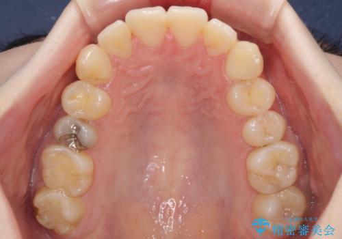 デコボコ歯列をきれいに インビザラインによる矯正治療の治療中