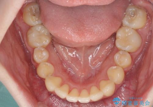 デコボコ歯列をきれいに　インビザラインによる矯正治療の治療中