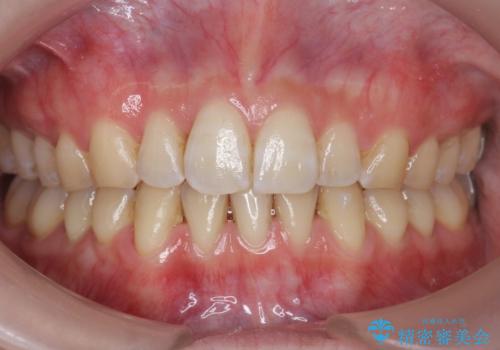 前歯のガタつき　インビザラインで　下の前歯を1本抜歯の症例 治療後