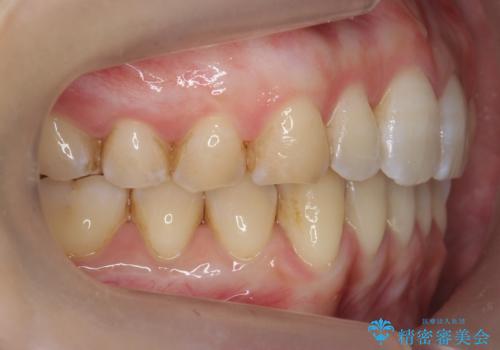 前歯のガタつき インビザラインで 下の前歯を1本抜歯の治療後