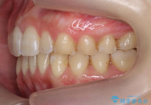 前歯のガタつき インビザラインで 下の前歯を1本抜歯の治療後