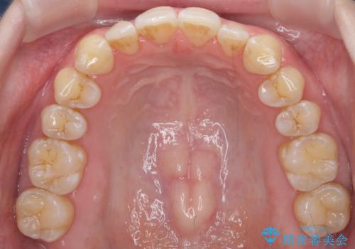 前歯のガタつき　インビザラインで　下の前歯を1本抜歯の治療後