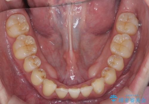 前歯のガタつき　インビザラインで　下の前歯を1本抜歯の治療後