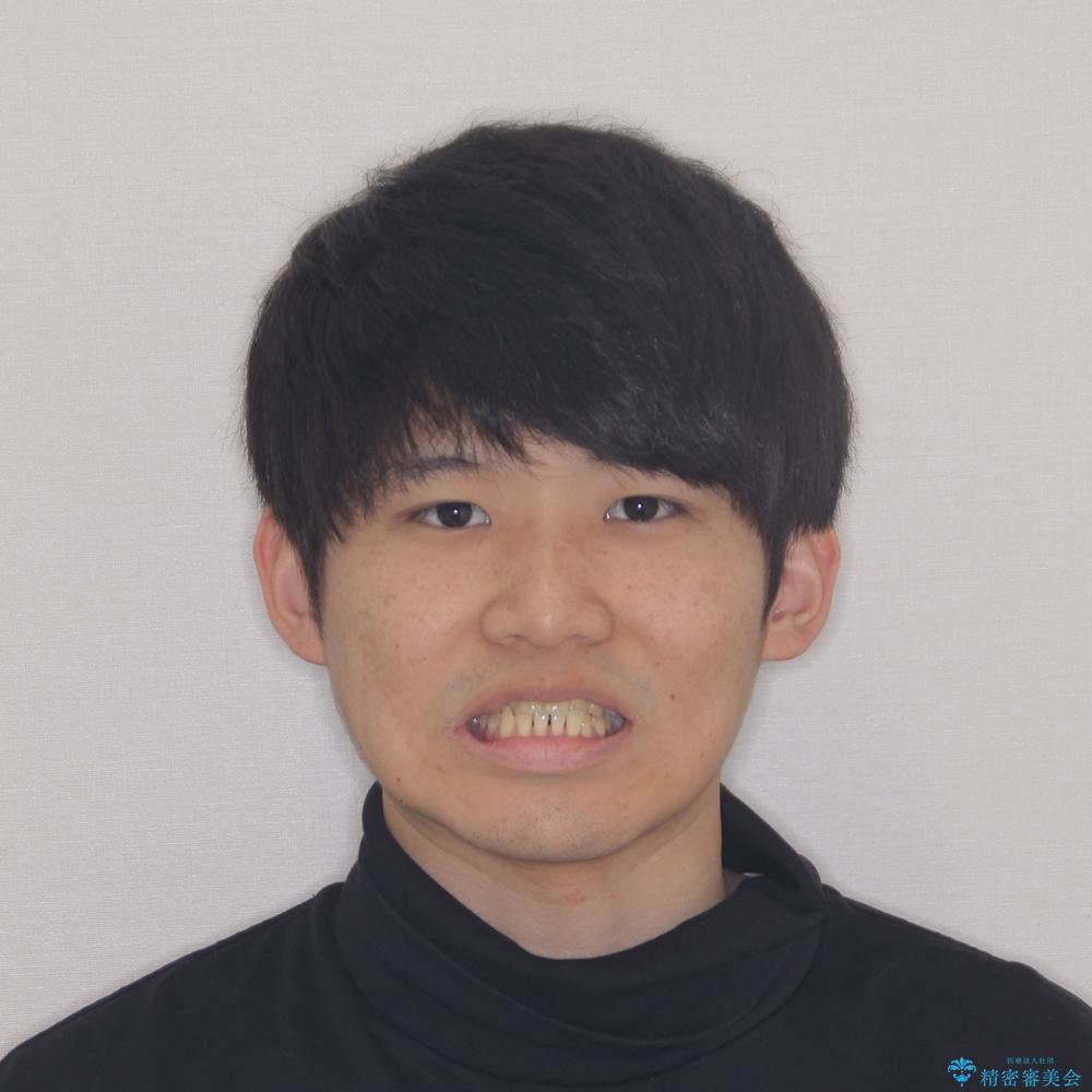 【モニター】前歯のクロスバイトと隙間を改善 インビザラインによる矯正治療の治療前(顔貌)