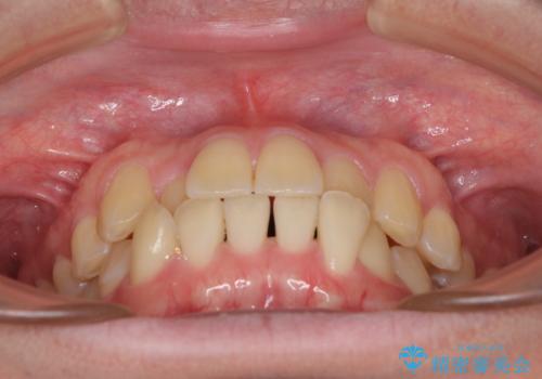 【モニター】前歯のクロスバイトと隙間を改善　インビザラインによる矯正治療の治療前