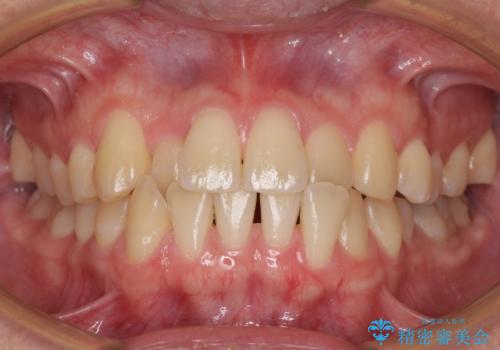 【モニター】前歯のクロスバイトと隙間を改善　インビザラインによる矯正治療の症例 治療前