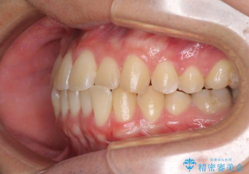 【モニター】前歯のクロスバイトと隙間を改善 インビザラインによる矯正治療の治療前