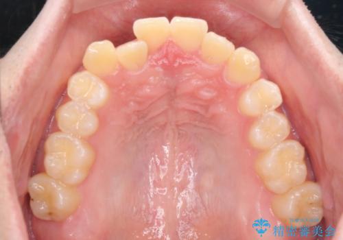 【モニター】前歯のクロスバイトと隙間を改善　インビザラインによる矯正治療の治療前