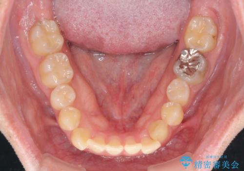 【モニター】前歯のクロスバイトと隙間を改善 インビザラインによる矯正治療の治療前