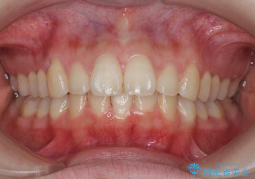 マウスピースで出っ歯感の改善の治療中