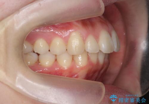 マウスピースで出っ歯感の改善の治療中
