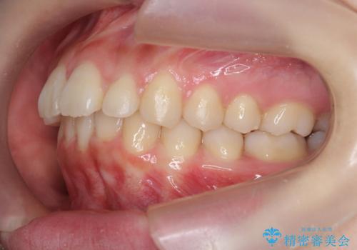 マウスピースで出っ歯感の改善の治療中