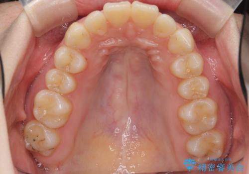 マウスピースで出っ歯感の改善の治療中
