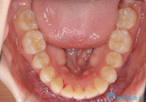 マウスピースで出っ歯感の改善の治療中