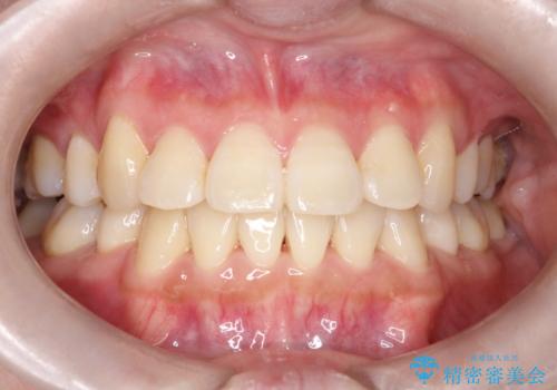 コンプレックスだった前歯のガタガタがここまで綺麗になるなんて!!の症例 治療後