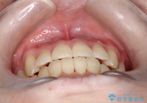 コンプレックスだった前歯のガタガタがここまで綺麗になるなんて!!の治療後
