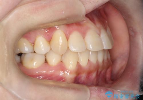 コンプレックスだった前歯のガタガタがここまで綺麗になるなんて!!の治療後