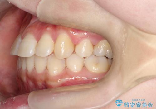 コンプレックスだった前歯のガタガタがここまで綺麗になるなんて!!の治療後
