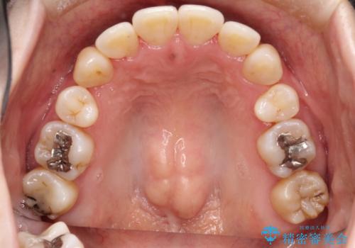 コンプレックスだった前歯のガタガタがここまで綺麗になるなんて!!の治療後