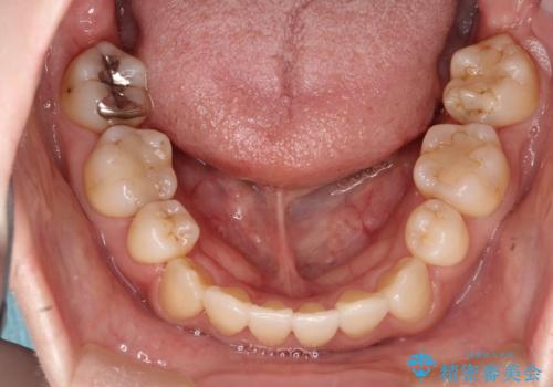 コンプレックスだった前歯のガタガタがここまで綺麗になるなんて!!の治療後