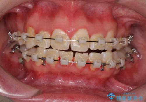 骨格的なズレをカムフラージュ 抜歯矯正で咬み合わせを改善の治療中