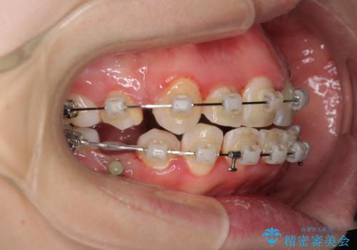 骨格的なズレをカムフラージュ　抜歯矯正で咬み合わせを改善の治療中