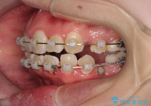 骨格的なズレをカムフラージュ　抜歯矯正で咬み合わせを改善の治療中