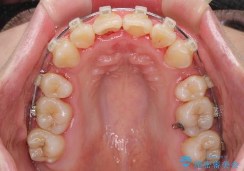 骨格的なズレをカムフラージュ 抜歯矯正で咬み合わせを改善の治療中