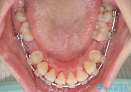 骨格的なズレをカムフラージュ 抜歯矯正で咬み合わせを改善の治療中