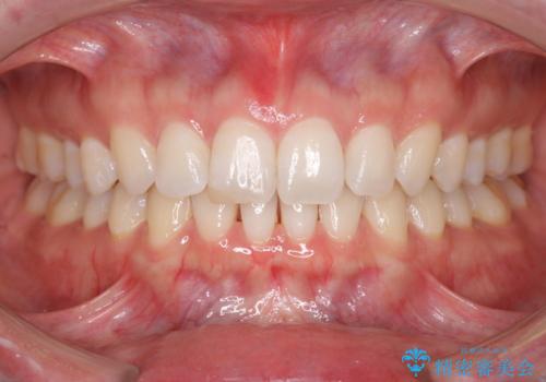 すきっ歯をインビザラインで目立たたずストレスなく矯正の症例 治療後