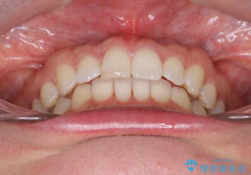 すきっ歯をインビザラインで目立たたずストレスなく矯正の治療後