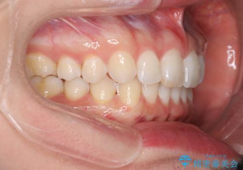 すきっ歯をインビザラインで目立たたずストレスなく矯正の治療後