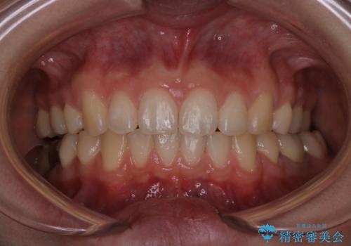 出っ歯の矯正　抜歯をしてしっかり引っ込めるワイヤー矯正の治療後