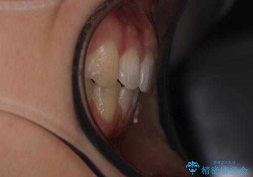 出っ歯の矯正 抜歯をしてしっかり引っ込めるワイヤー矯正の治療後