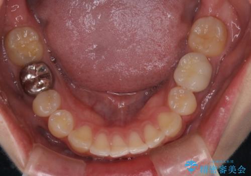 出っ歯の矯正　抜歯をしてしっかり引っ込めるワイヤー矯正の治療後