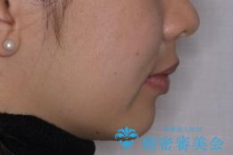 出っ歯の矯正 抜歯をしてしっかり引っ込めるワイヤー矯正の治療後(顔貌)