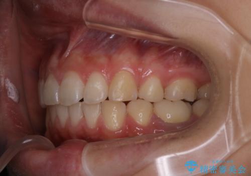 出っ歯の矯正　抜歯をしてしっかり引っ込めるワイヤー矯正の症例 治療後