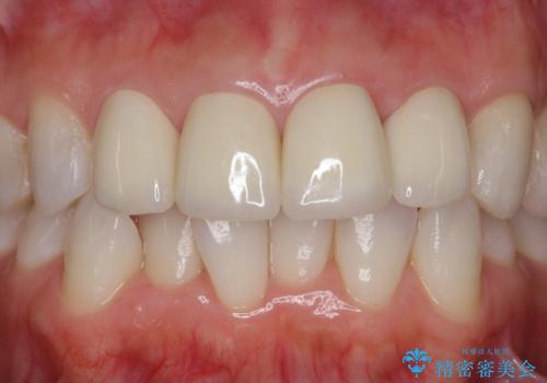 つぎはぎの前歯をセラミックにしたいの治療後