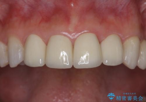つぎはぎの前歯をセラミックにしたいの症例 治療後