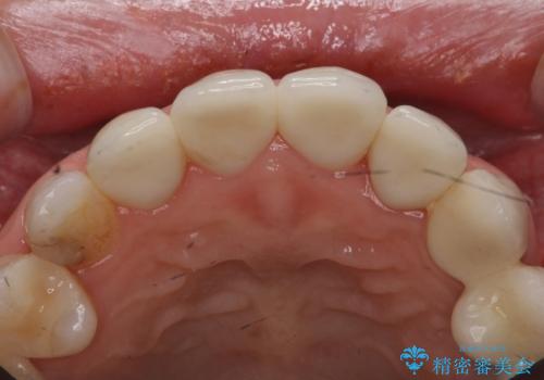 つぎはぎの前歯をセラミックにしたいの治療後