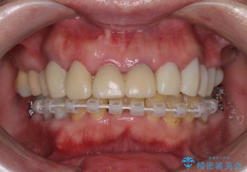 銀歯や入れ歯で汚い歯をきれいにしたい　総合歯科治療の治療中