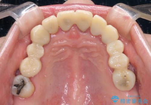 銀歯や入れ歯で汚い歯をきれいにしたい　総合歯科治療の治療中