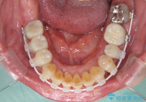銀歯や入れ歯で汚い歯をきれいにしたい 総合歯科治療の治療中