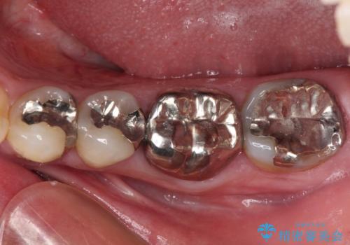 欠損と痛み　奥歯のむし歯治療の治療前