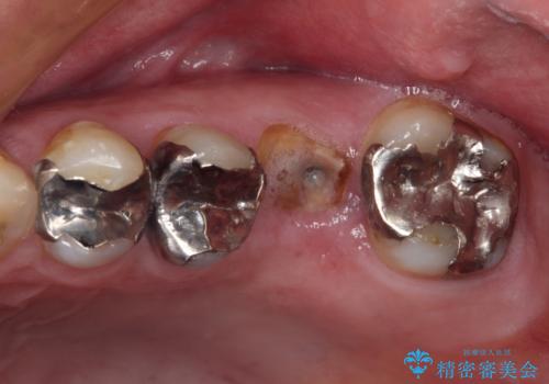 欠損と痛み　奥歯のむし歯治療の症例 治療前
