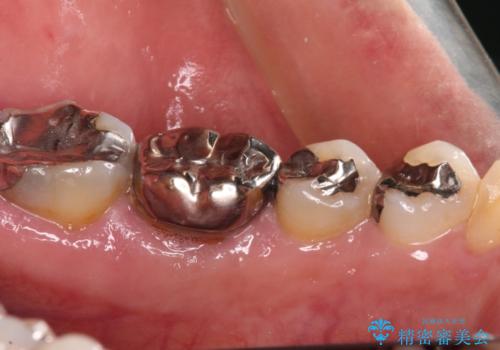 欠損と痛み 奥歯のむし歯治療の治療前