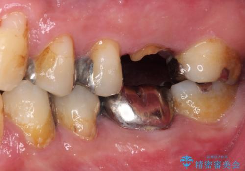欠損と痛み 奥歯のむし歯治療の治療前