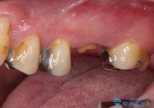 欠損と痛み　奥歯のむし歯治療の治療前